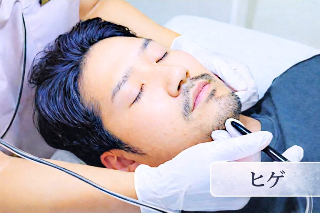 千葉県柏市の美容電気脱毛（ニードル脱毛）サロンReMoveのHP内にある、ニードル脱毛中のモデルの画像。男性、髭