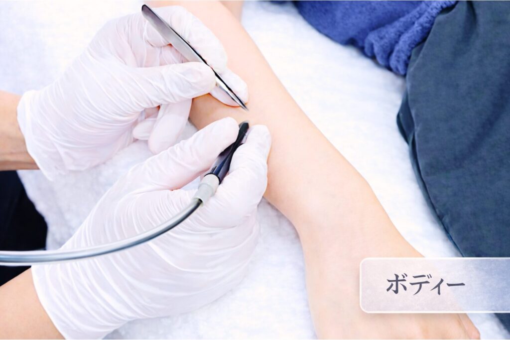 千葉県柏市の美容電気脱毛（ニードル脱毛）サロンReMoveのHP内にある、ニードル脱毛中のモデルの画像。女性、ボディー