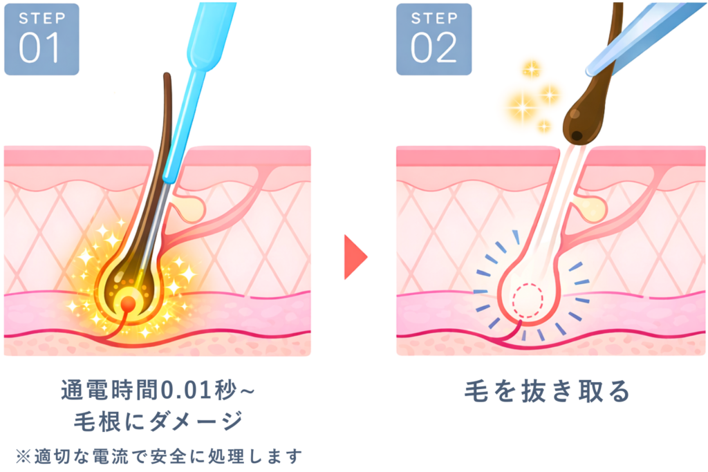 千葉県柏市の美容電気脱毛（ニードル脱毛）サロンReMoveのHPのニードル脱毛のイメージ図