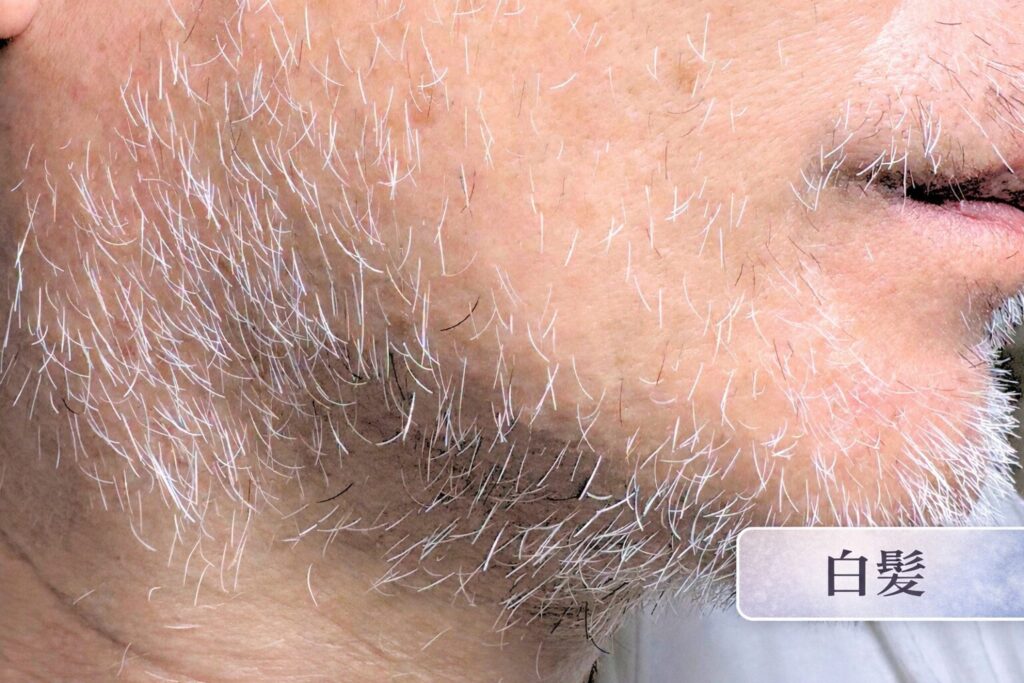 千葉県柏市の美容電気脱毛（ニードル脱毛）サロンReMoveのHP内にある、ニードル脱毛中のモデルの画像。男性、白髪脱毛