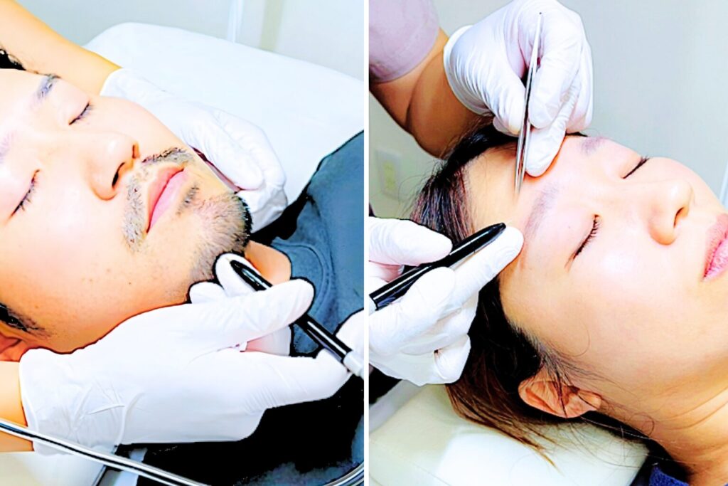 千葉県柏市の美容電気脱毛（ニードル脱毛）サロンReMoveのHPのニードル脱毛中のイメージ写真