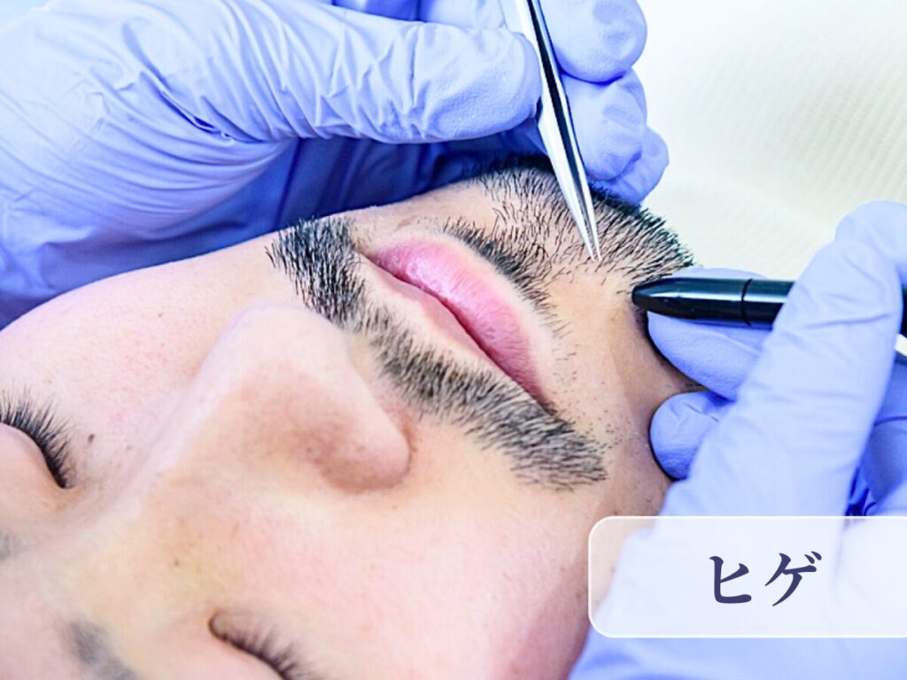 千葉県柏市の美容電気脱毛(ニードル脱毛)サロンReMoveのHP内にある、ニードル脱毛中のモデルの画像。男性、髭脱毛