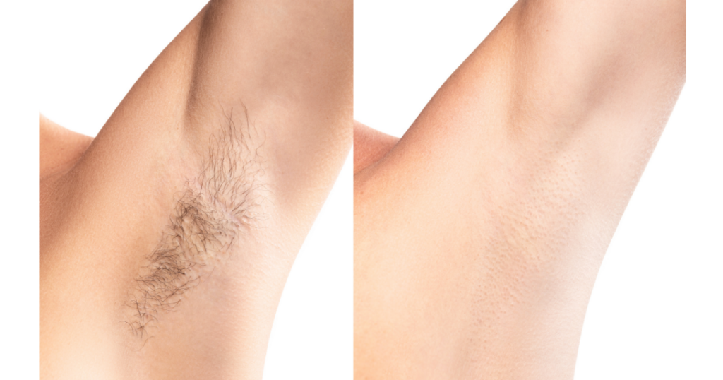 柏市 美容電気脱毛 （ニードル脱毛）ReMove