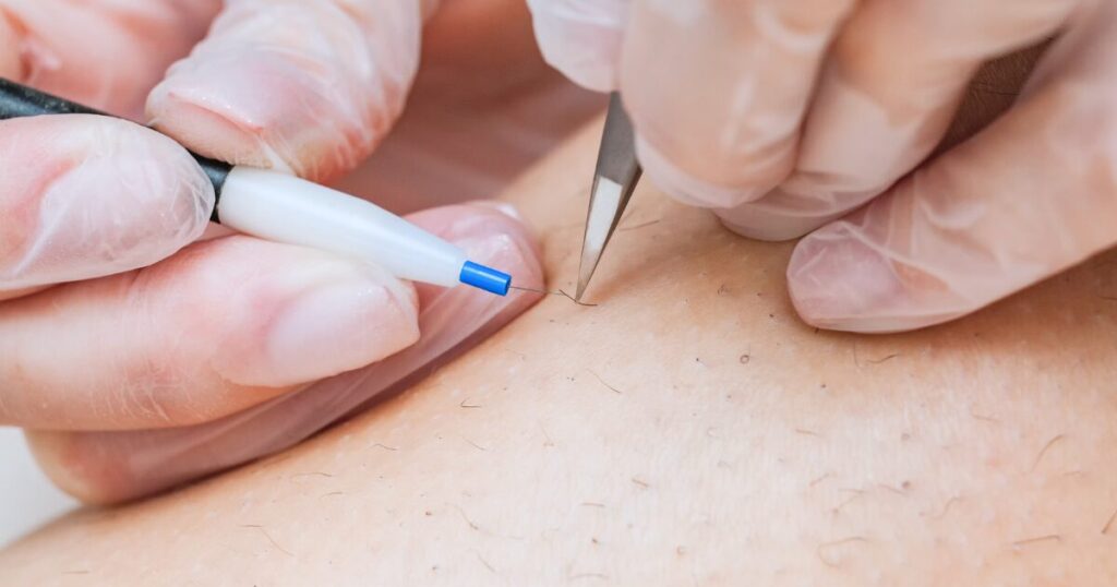 柏市 美容電気脱毛 （ニードル脱毛）ReMove