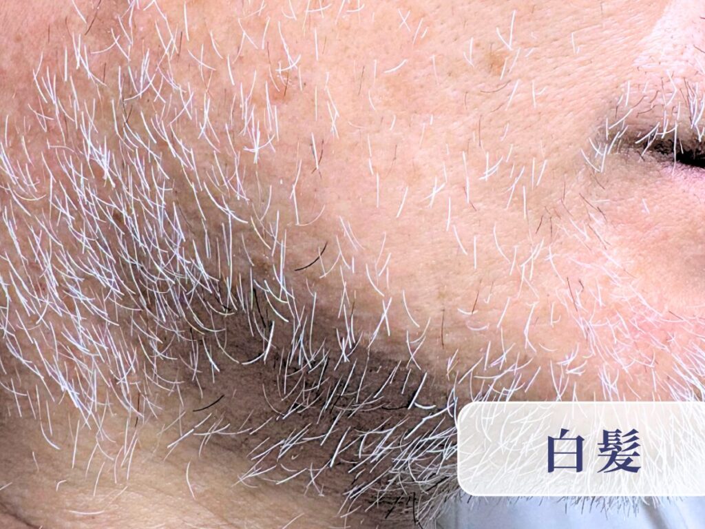 千葉県柏市の美容電気脱毛(ニードル脱毛)サロンReMoveのHP内にある、ニードル脱毛中のモデルの画像。男性、白髪脱毛