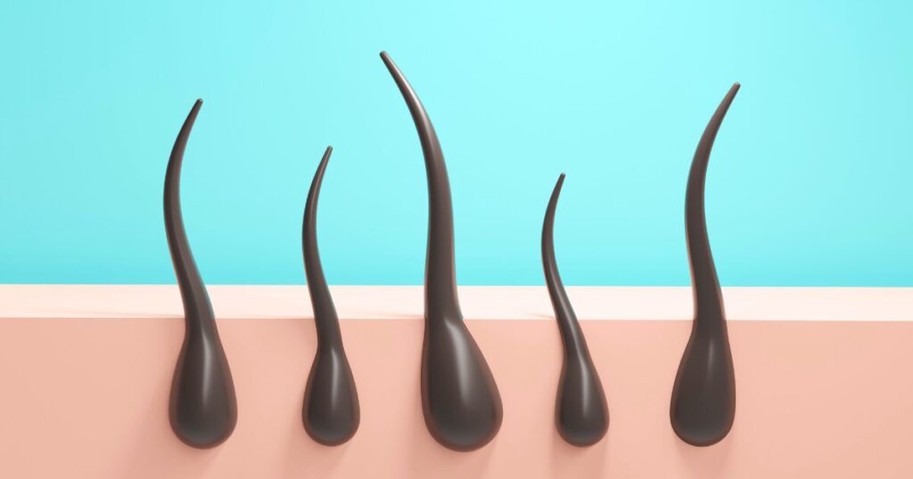 柏市 美容電気脱毛 （ニードル脱毛）ReMove