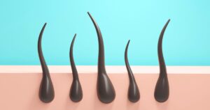 柏市 美容電気脱毛 （ニードル脱毛）ReMove