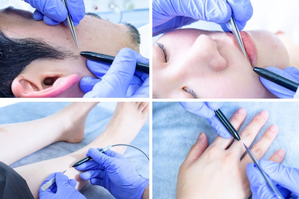 千葉県柏市の美容電気脱毛(ニードル脱毛)サロンReMoveの脱毛の様子