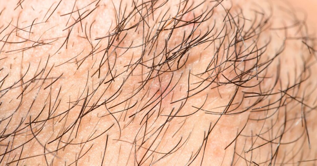 柏市 美容電気脱毛 （ニードル脱毛）ReMove