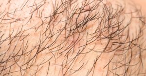 柏市 美容電気脱毛 （ニードル脱毛）ReMove