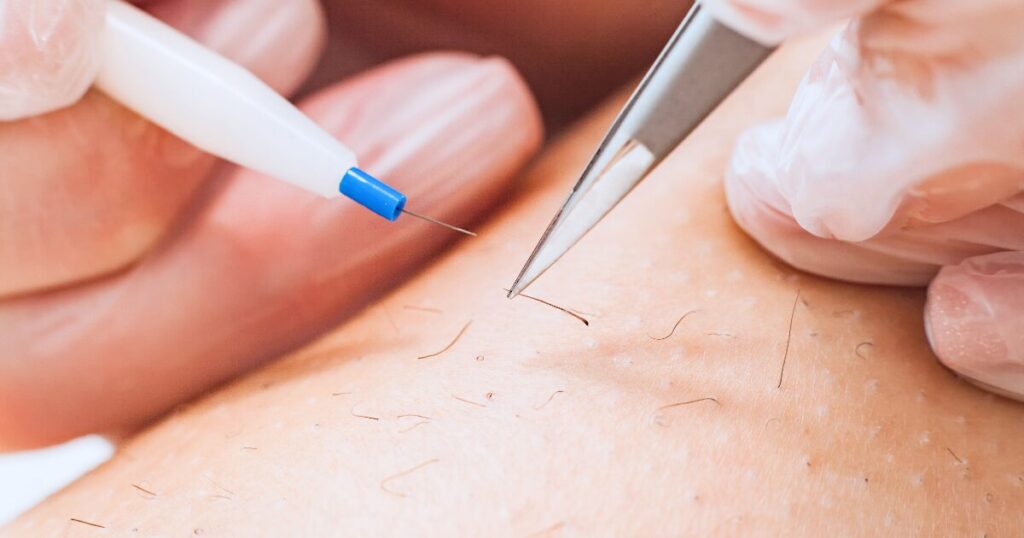 柏市 美容電気脱毛 （ニードル脱毛）ReMove