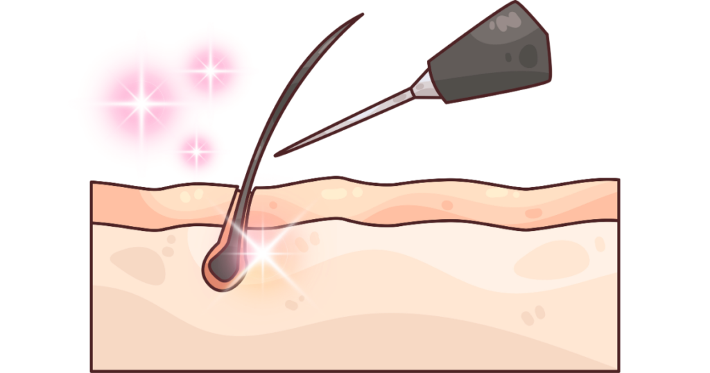 柏市 美容電気脱毛 （ニードル脱毛）ReMove