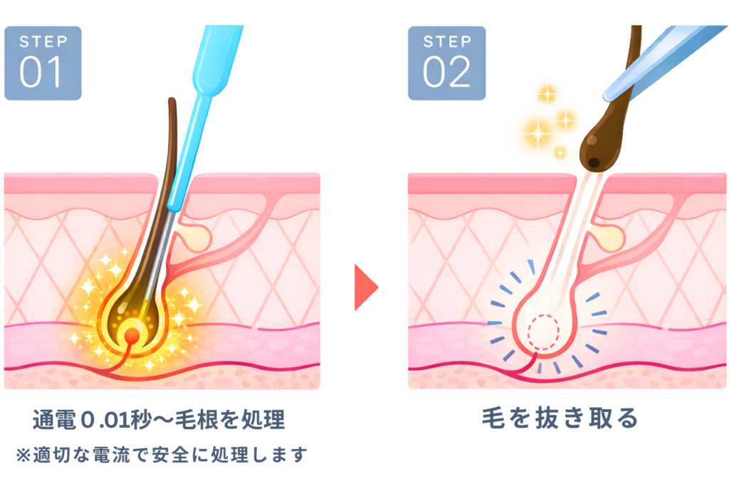千葉県柏市の美容電気脱毛(ニードル脱毛)サロンReMoveのニードル脱毛のイメージ写真